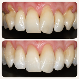 Composite Bonding Befor After