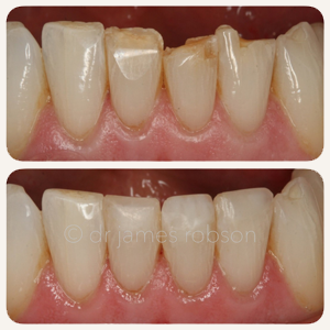 Composite Bonding Befor After