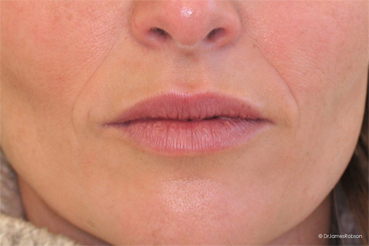 Lip Enhancement