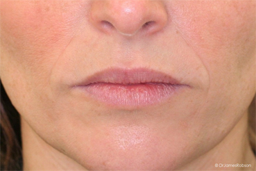 Lip Enhancement