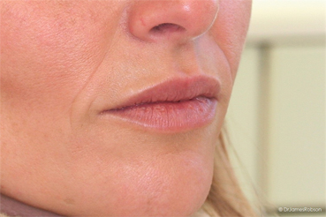 Lip Enhancement