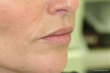 Lip Enhancement